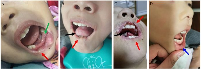 Lesch nyhan syndrome